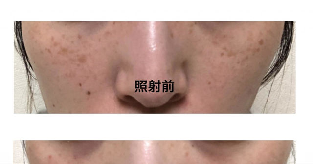 シミとりレーザー治療 本気のレポ Antenna アンテナ