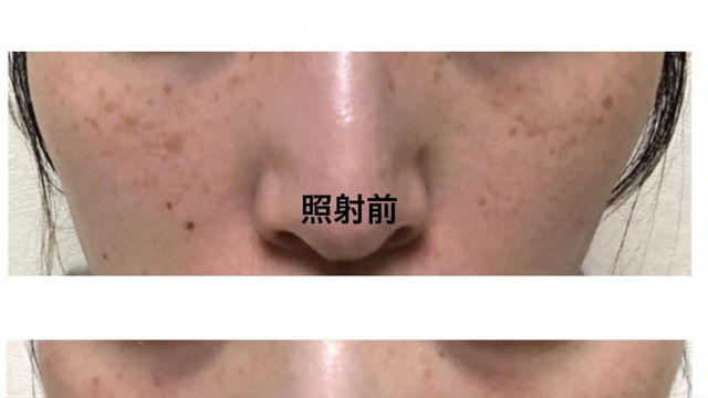 シミとりレーザー治療 本気のレポ Antenna アンテナ