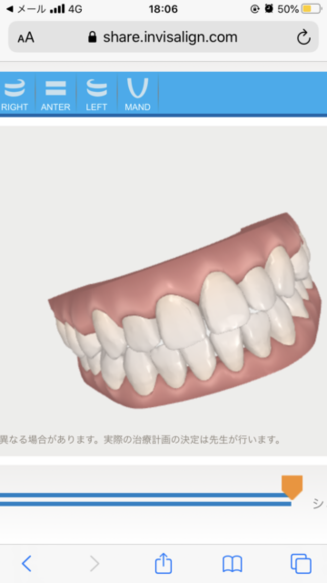 バレない歯科矯正 Antenna アンテナ