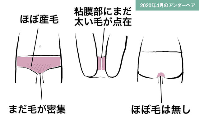 コロナでvio脱毛を半年中断 アンダーヘアはまた元どおりに生えてくる Vio脱毛からデリケートゾーンケア 女性の体のことまで もっとおしゃれに大人もナチュラルライフを楽しもう Antenna アンテナ