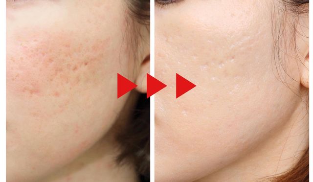 最終レポ タカミクリニック でクレーターと大人ニキビと決別 Antenna アンテナ