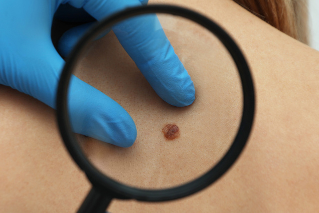 皮膚がんの可能性はありますか？病気の見分け方