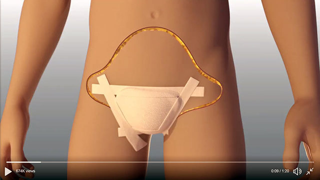 左耳を失った米女性兵士 前腕で育てた耳の移植手術に成功 Antenna アンテナ