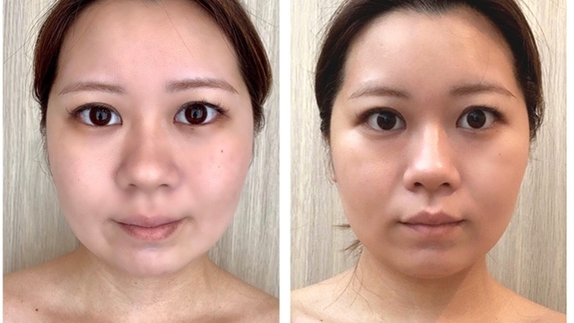 ほうれい線が消える 小顔になる 美肌 美白も叶う すんごいアンチエイジング マシンに出合いました Antenna アンテナ